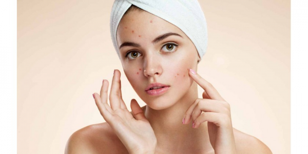 Homéopathie pour le traitement de l'acné