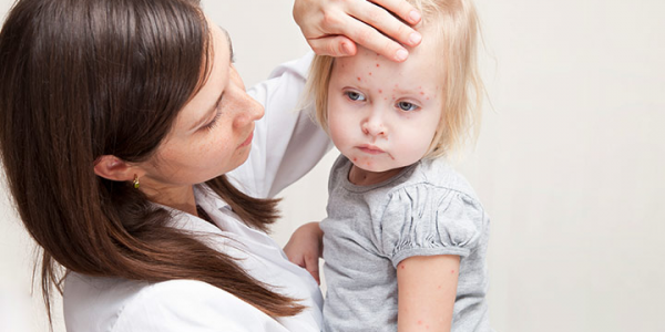 Remedios homeopáticos para la varicela y el sarampión