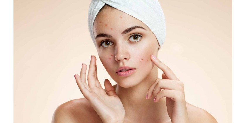 Homéopathie pour le traitement de l'acné